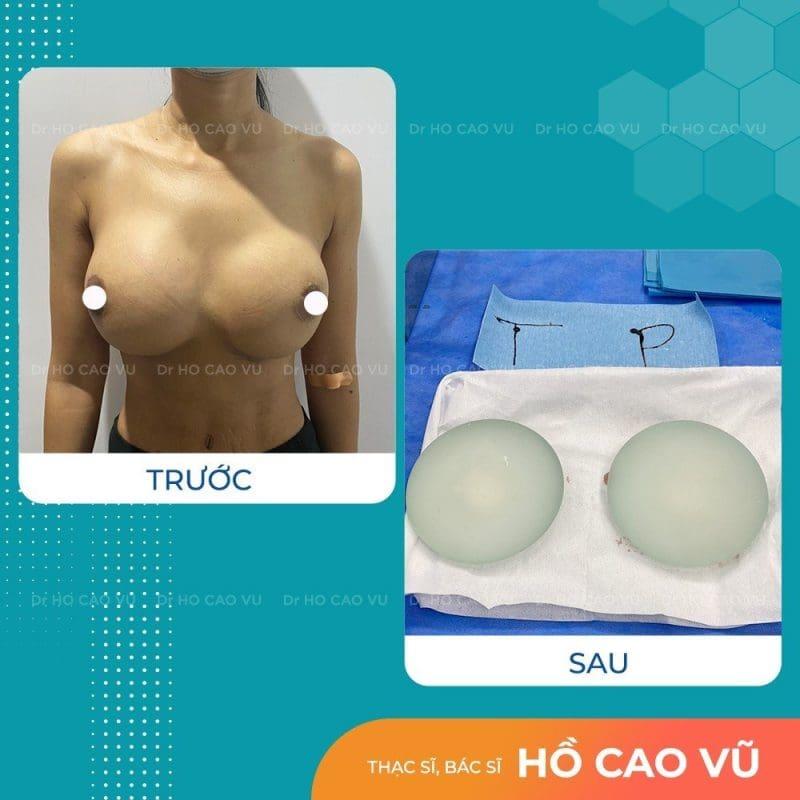 Biến chứng nâng ngực bị thông khe sau phẫu thuật