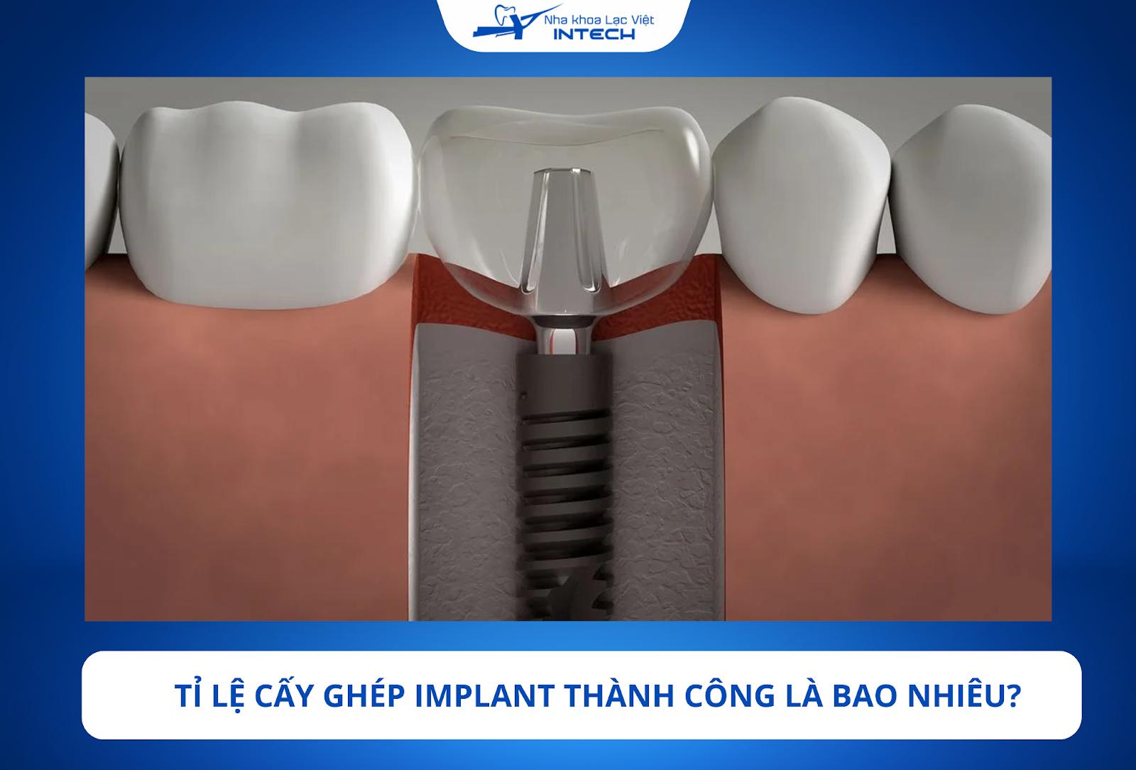Hé lộ tỉ lệ cấy ghép răng Implant thành công và thất bại